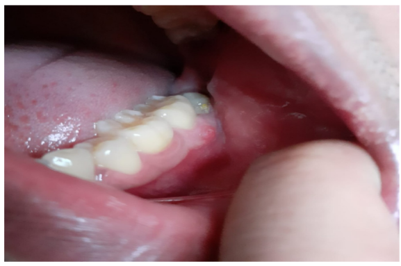 After Treatment