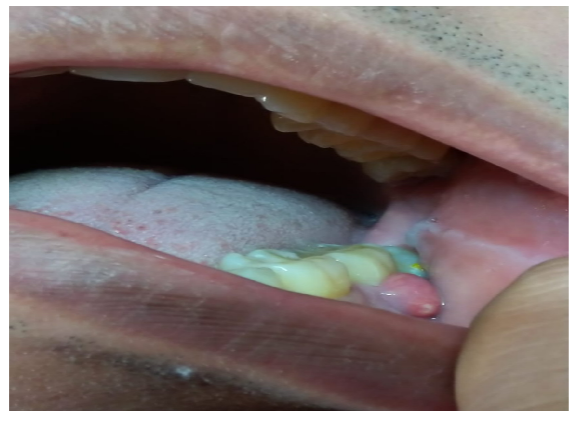 Before Treatment