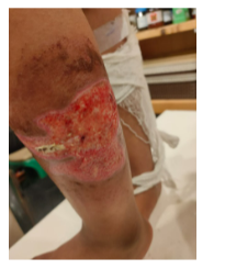 After Treatment