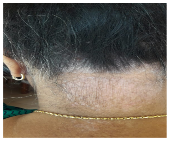 After Treatment