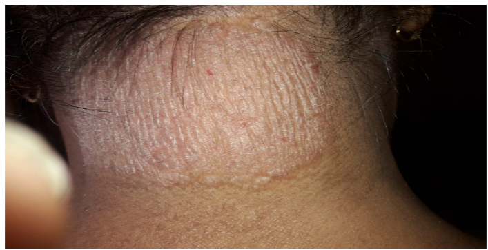 Before Treatment